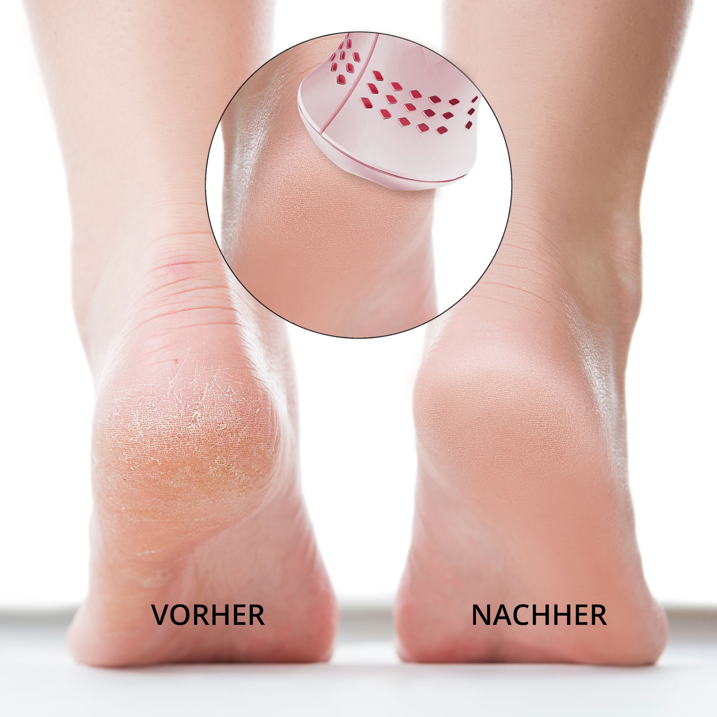 AILORIA Elektrischer Hornhautentferner »Elektrischer Hornhautentferner (USB) LUSTRE«