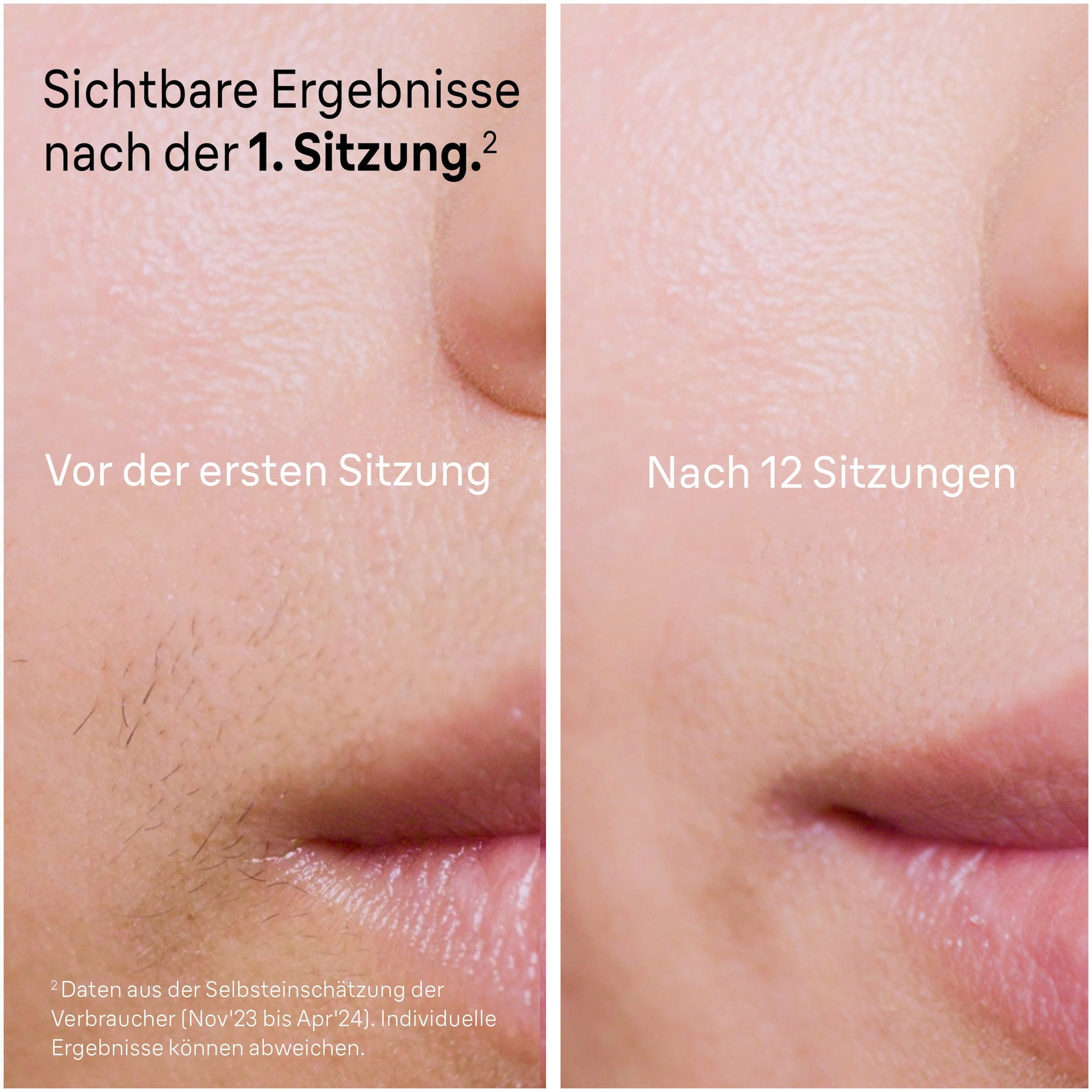 Braun IPL-Haarentferner »Smart Skin i·expert PL7249«, 3 Aufsätze für Gesicht & Körper, Venus Rasierer, Mini-Rasierer