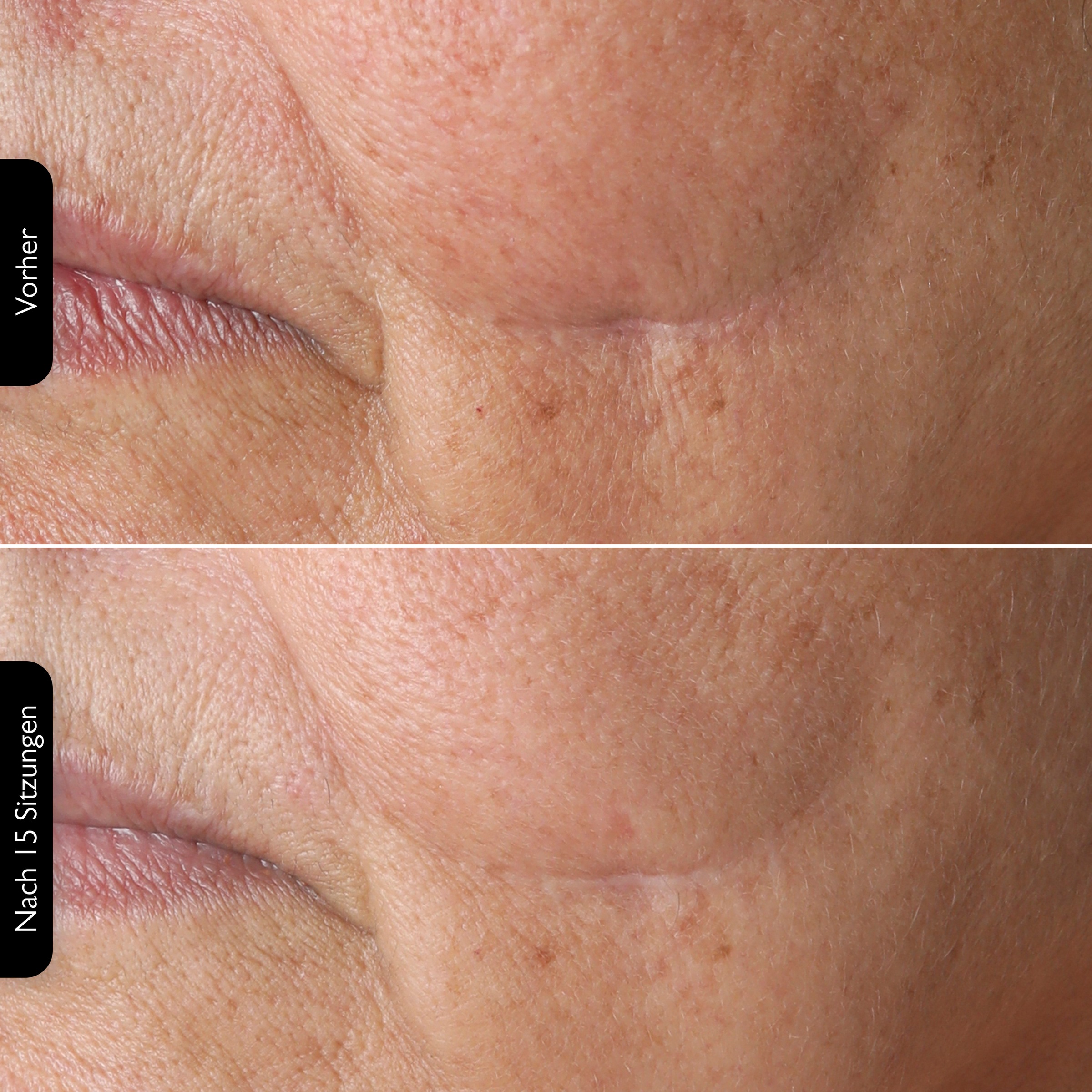 Silk'n Anti-Aging-Gerät »FaceTite Multiplatform«, Multifunktionsfähig
