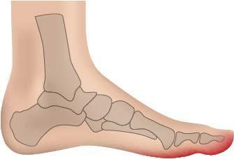 Fußgut Überbeinschutz, mit Gelpolster, lindert Schmerzen bei Hallux Valgus