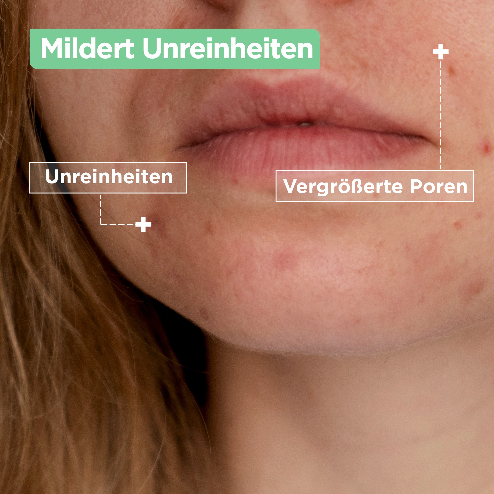 Mixa Gesichtspflege »Mixa Anti-Unreinheiten Gel-Creme«, mit hoher Wirksamkeit