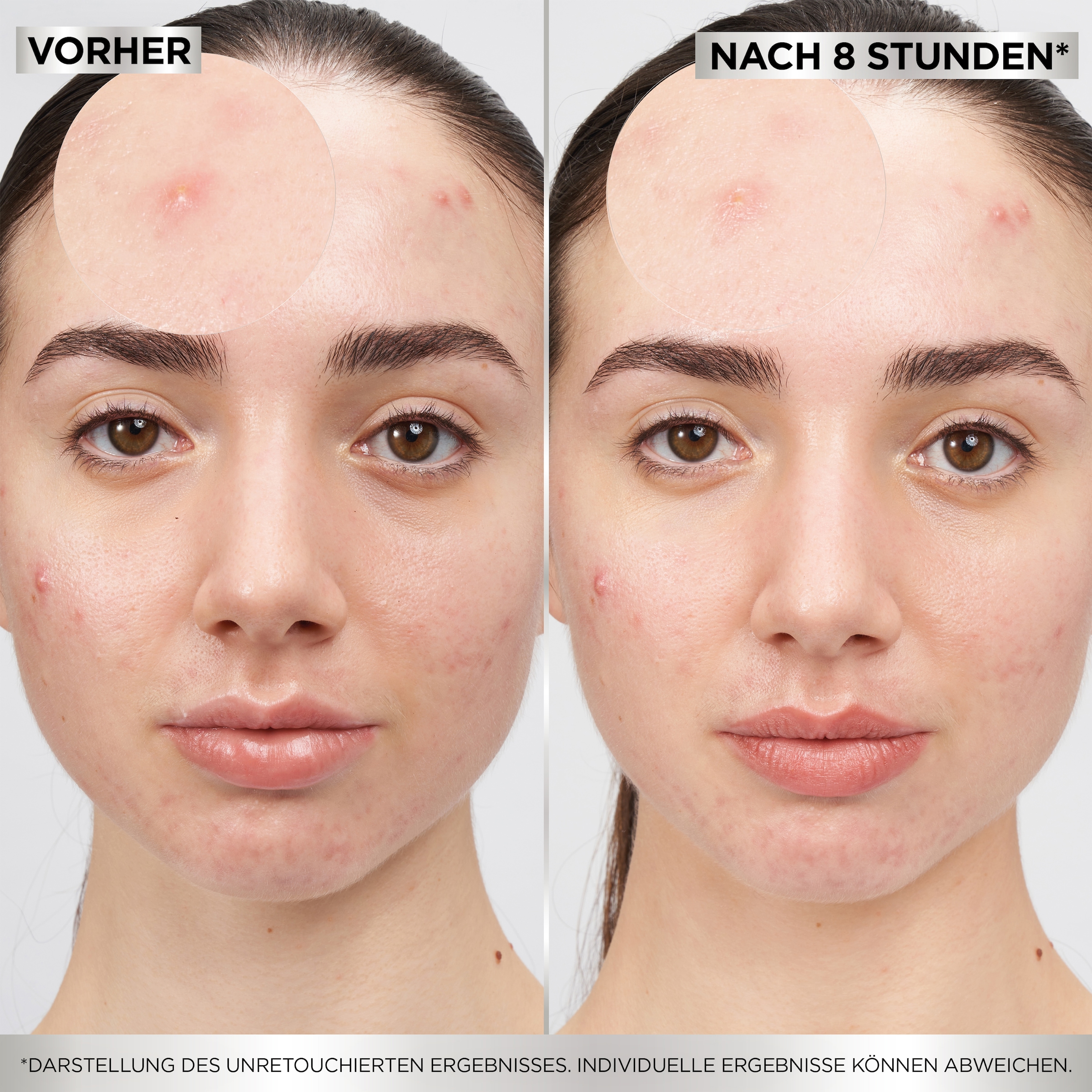 GARNIER Pflegestift »Garnier 8H Invisible Pimple Patch«