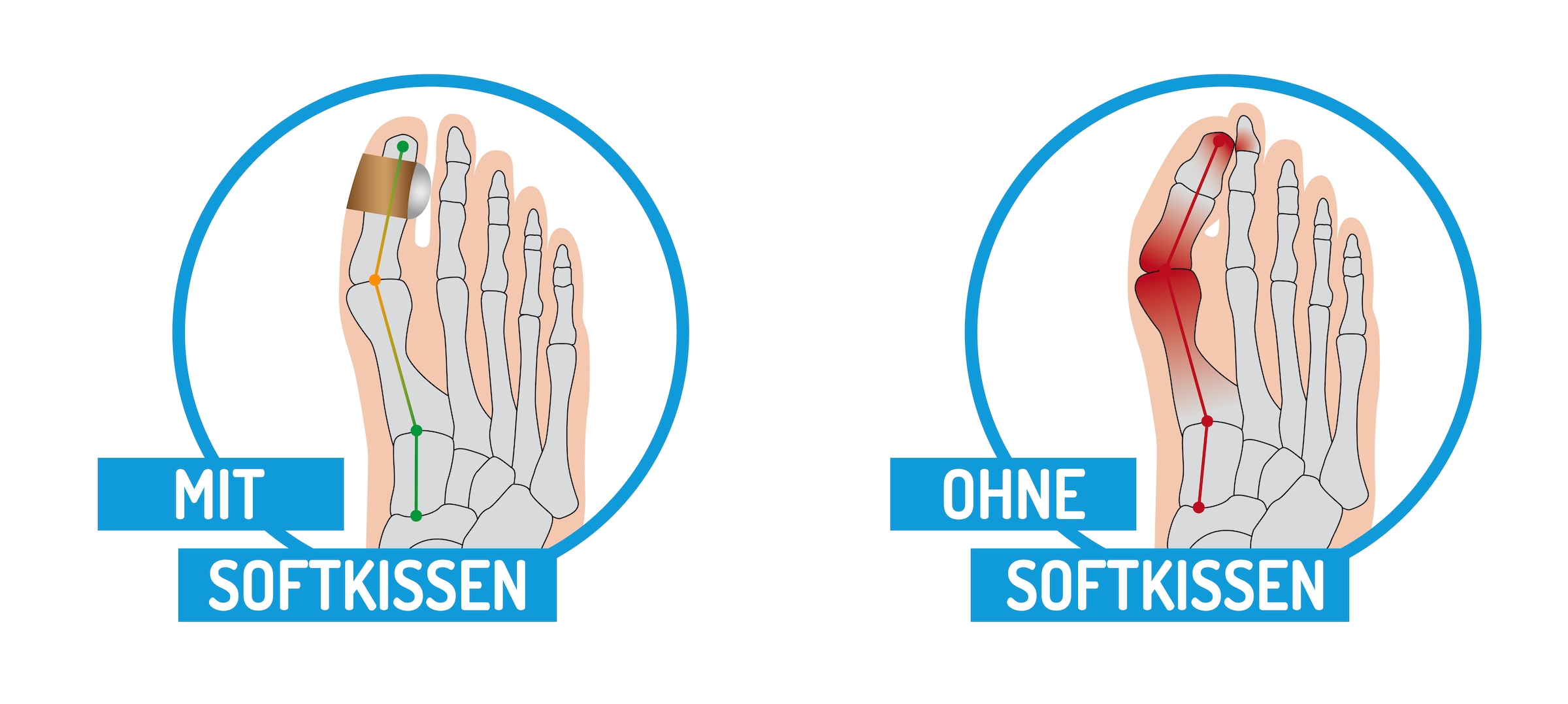 Fußgut Hallux-Bandage »Softkissen mit Fixierband, verhindert Reiben«, Druckentlastung bei Hühneraugen, Schwielen, Entlastung Hallux Valgus