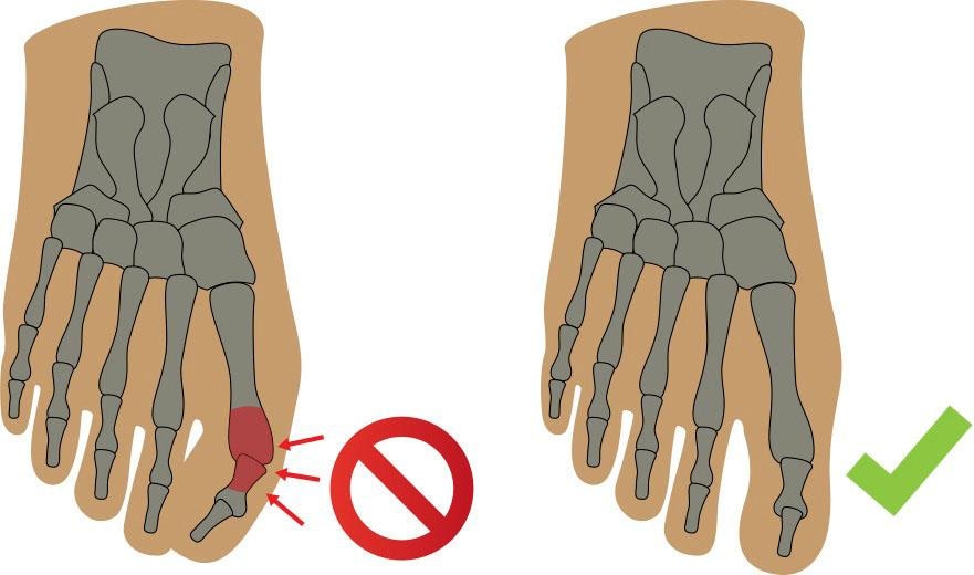 Fußgut Überbeinschutz, mit Gelpolster, lindert Schmerzen bei Hallux Valgus