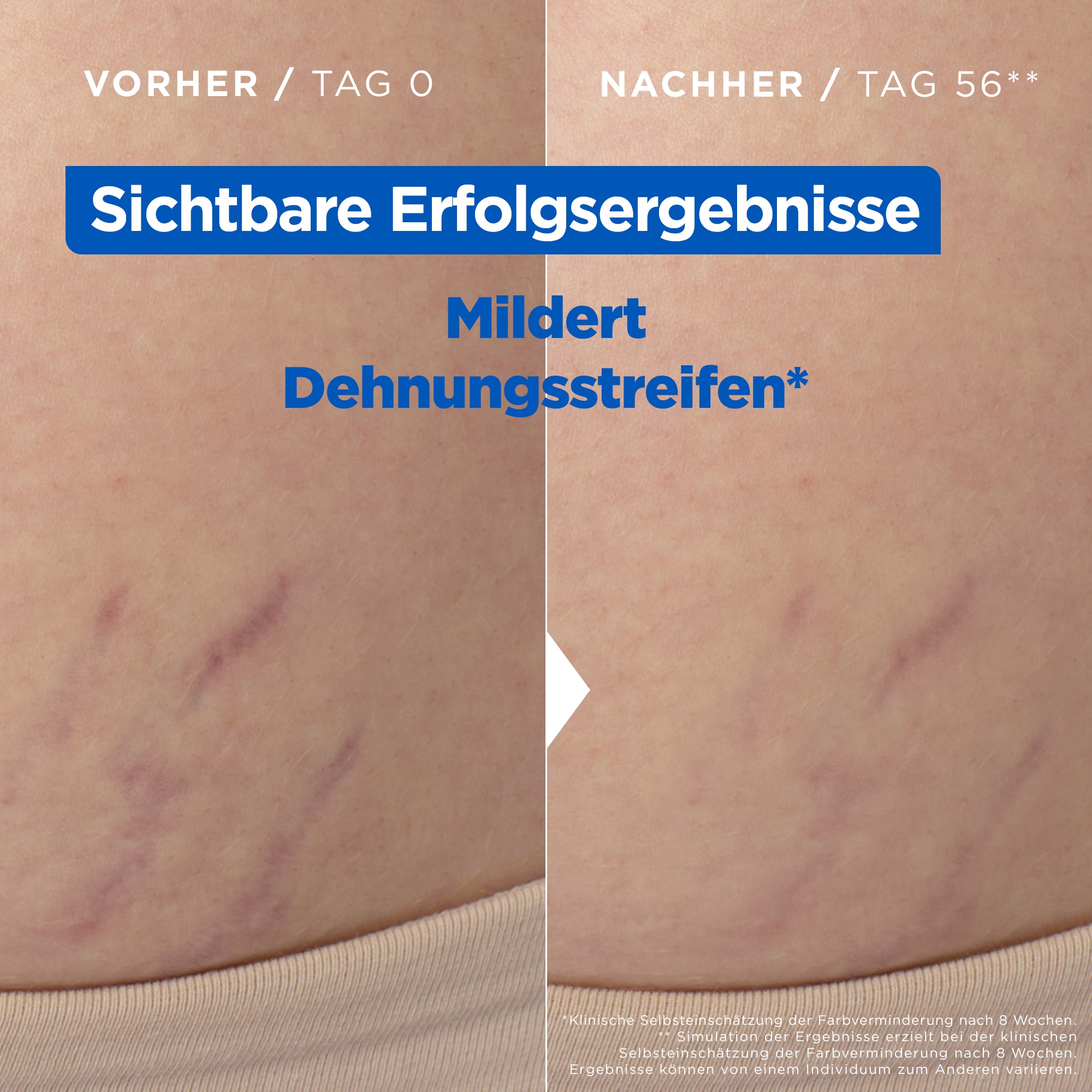 Mixa Körperlotion »Mixa Niacinamide Stretchmark Oil«