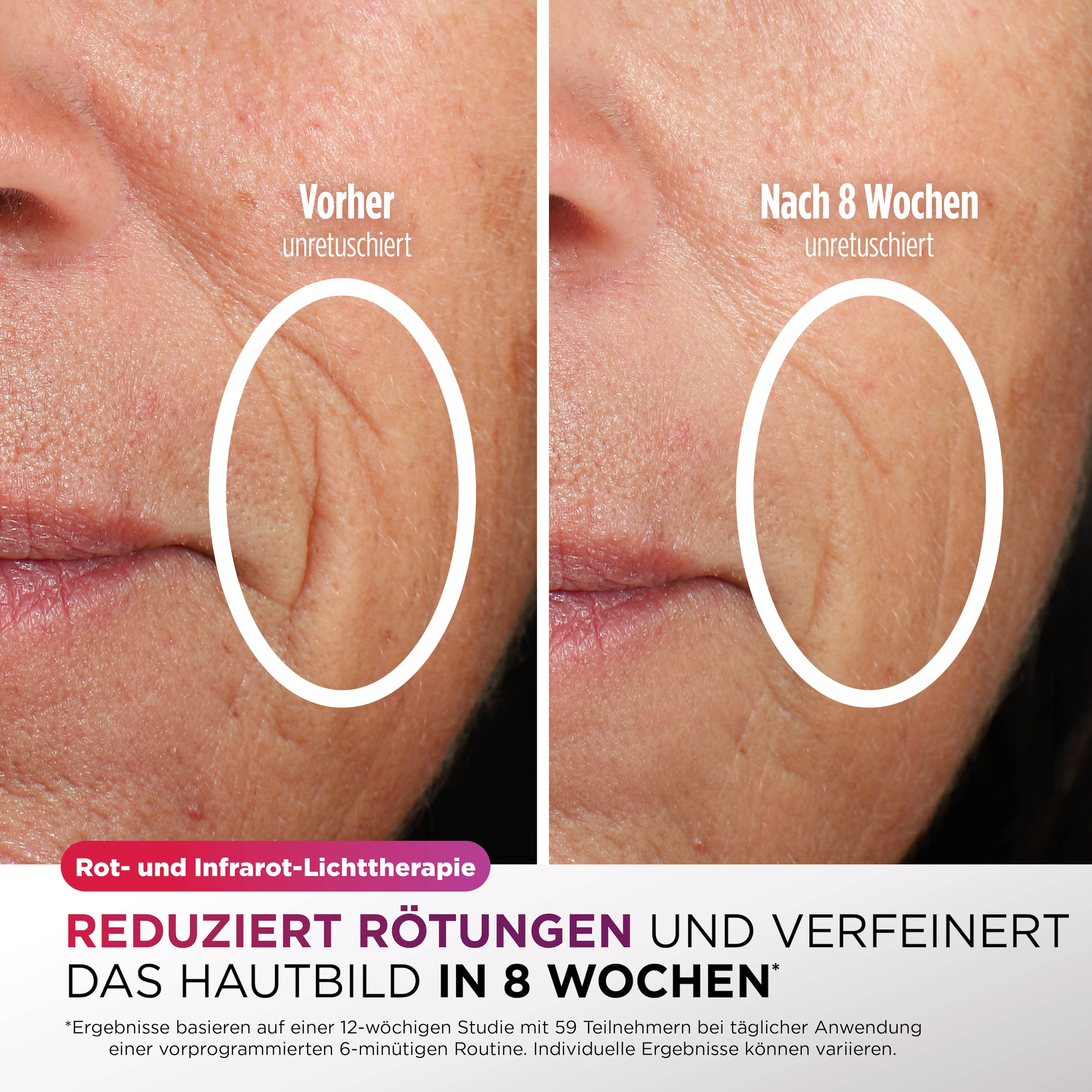 Shark LED-Gesichtsmaske »Shark CryoGlow LED-Maske + Kühlung der Augenpartie FW312EUPL« CryoGlow - unsere neue medizinisch zertifizierte Innovation