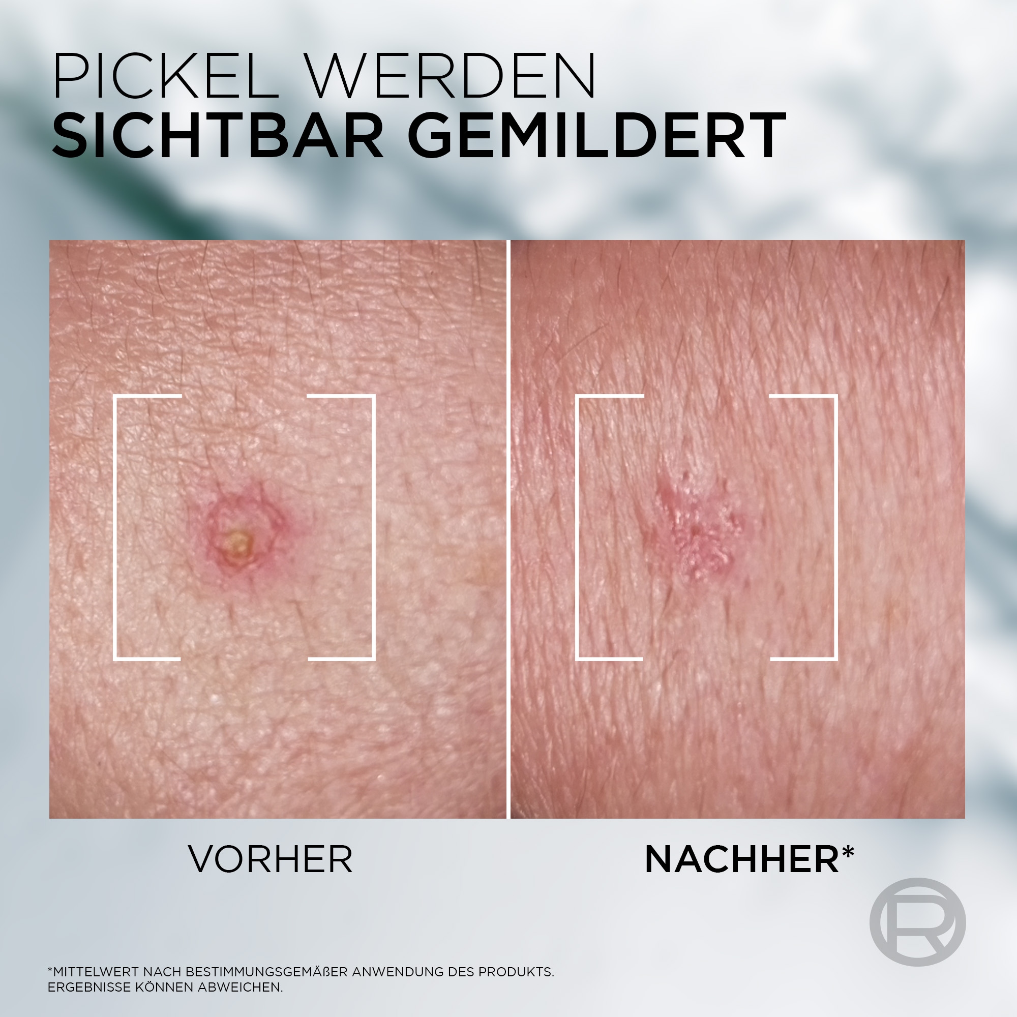 L'ORÉAL PARIS MEN EXPERT Pflegestift »L'Oréal Men Expert Derma Control S.O.S. 2in1 Anti-Pickel Paste«